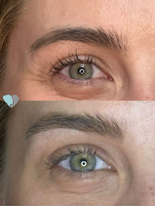 Before and after cheek filler and Botox
