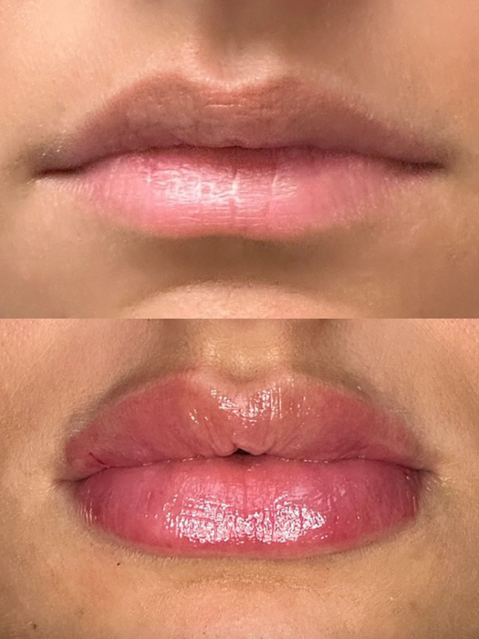 Before and after lip filler