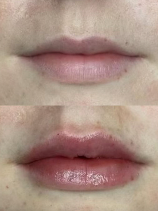 Before and after lip filler