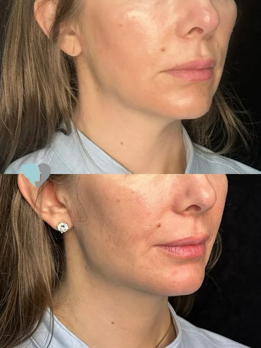 Before and after jawline filler