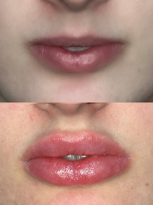 Before and after lip filler