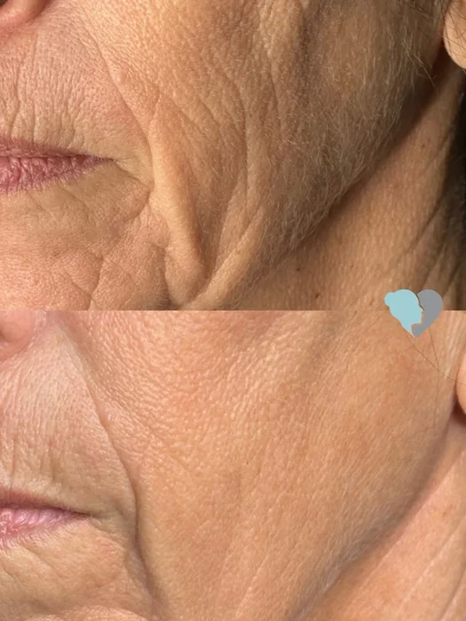 Before and after microneedling