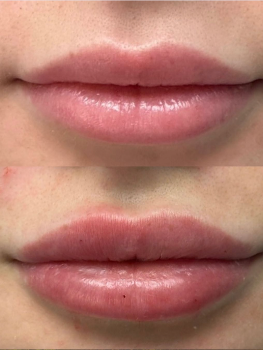 Before and after lip filler