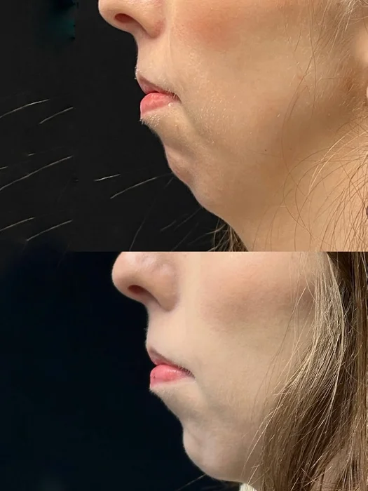 Injectable treatment results