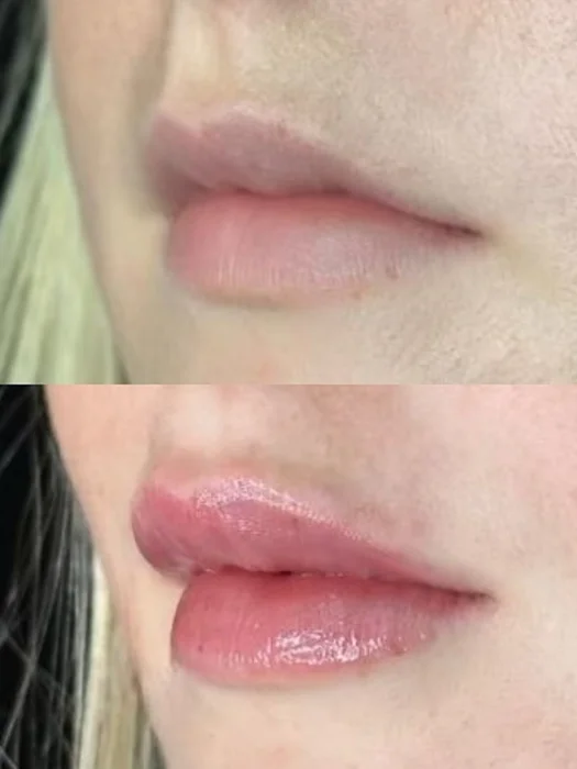 Injectable treatment results