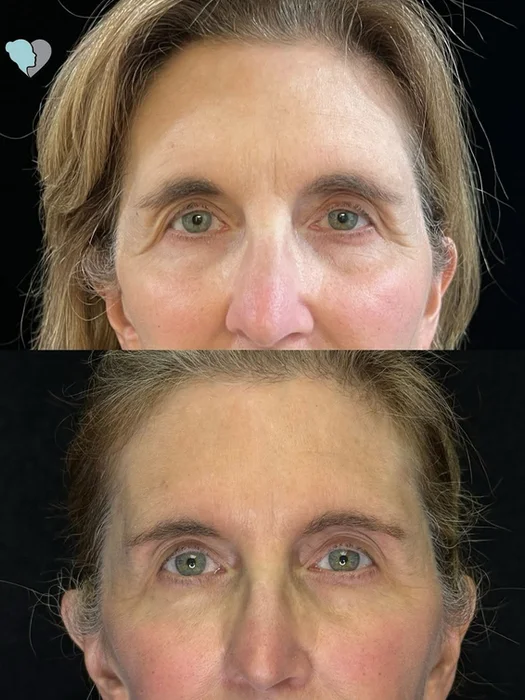 Before and after temple filler